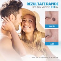 Dispozitiv Indepartare Papiloame prin Ligaturare, LittleDomi, Skin Tag Removal Kit, pentru Fata, Gat, Corp, Dimensiuni - 5