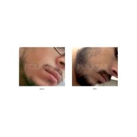 Foligain Minoxidil 5% Solutie cresterea parului barbati (Alcool scazut) 3 luni - 2