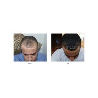 Foligain Minoxidil 5% Solutie cresterea parului barbati (Alcool scazut) 3 luni - 4