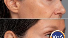 Toxina botulinica - interventii de succes la Clinica Estet Laser