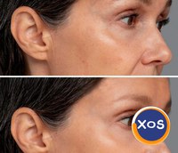 Toxina botulinica - interventii de succes la Clinica Estet Laser - 1