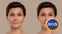 Toxina botulinica - interventii de succes la Clinica Estet Laser - 3